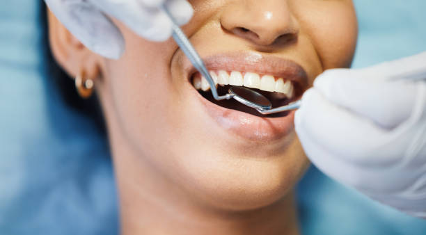 Best Emergency Wisdom Teeth Removal in Hanahan, SC